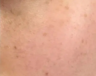 韩国祛斑选哪家皮肤科？韩国首尔丽格/丽妍K/童颜中心等祛斑各有优势